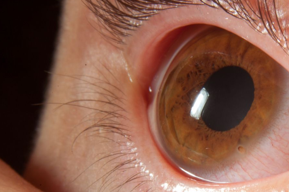 Corneal Disorders